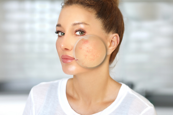 Fact or Myth: Is it Possible to Spot Treat Acne?